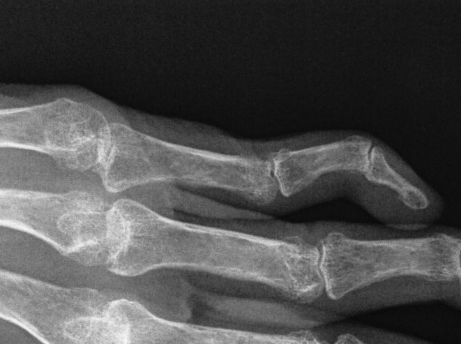 Rheumatoid Finger Swan Neck Xray